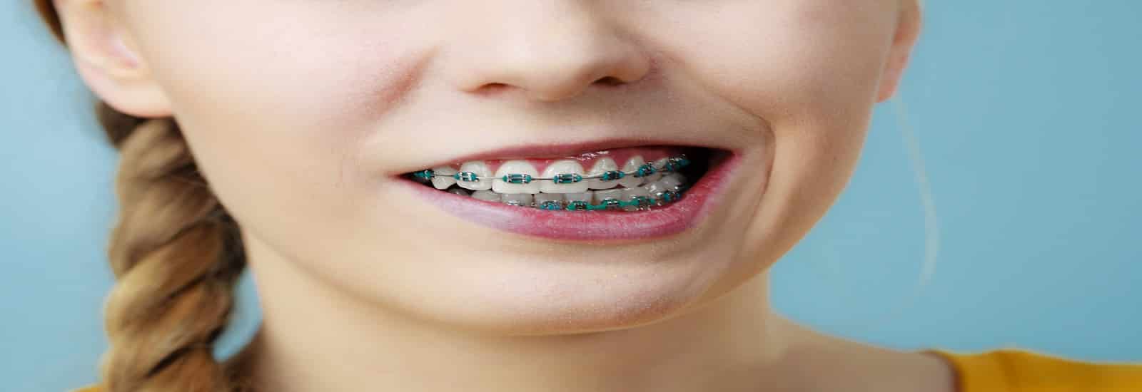 Elastics For Braces – Sabka Dentist – Top Dental Clinic Chain In India