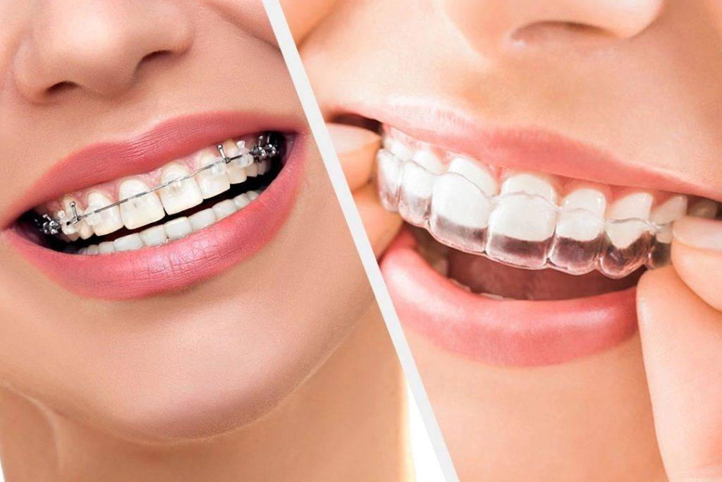 Clear braces vs Invisalign