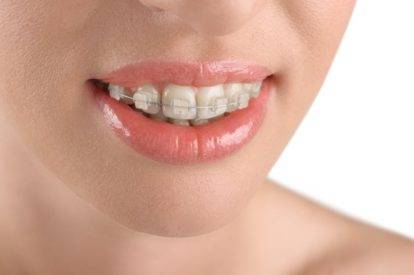 Clear braces