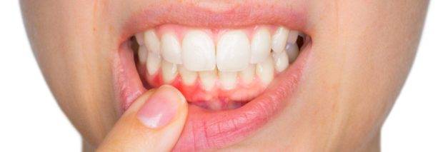 Best Gum Surgery Cost In India Periodontal Flap Surgery Cost In India