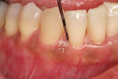 Braces for Gapped Teeth