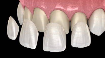 Teeth veneers