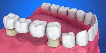 Dental Bridges in BTM Layout