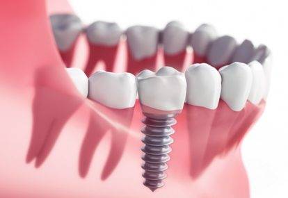 Dental Implants in Paldi 