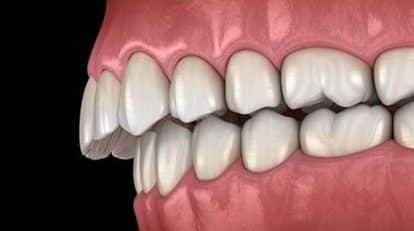 Overbite treatment with braces dentist near me
