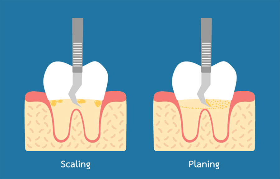 Scaling and Root Planning