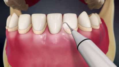 Tooth scaling in Vasant Vihar
