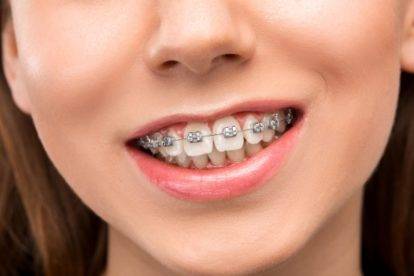 braces treatment in Sion East