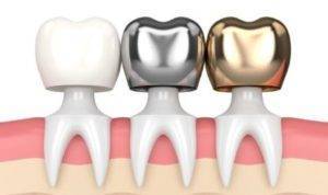 Dental Crowns Treatment in Ahmedabad