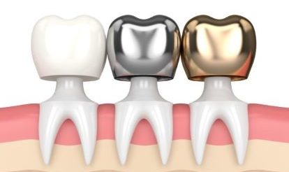 dental crown treatment in Bopal
