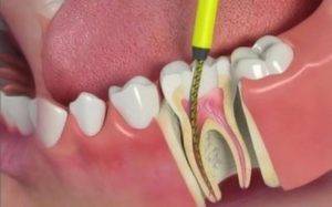 best-dentist-in-mumbai-for-Root-Canal-Treatment