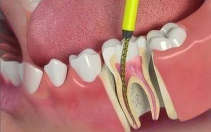 Wisdom Tooth Removal Service at best price in Vadodara