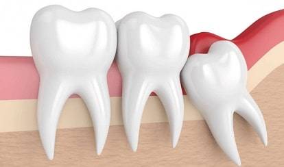 wisdom-tooth-extraction