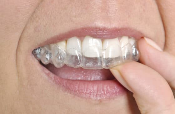 Affordable Invisible Braces