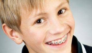 braces for Teeth