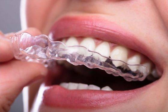 clear aligner treatment