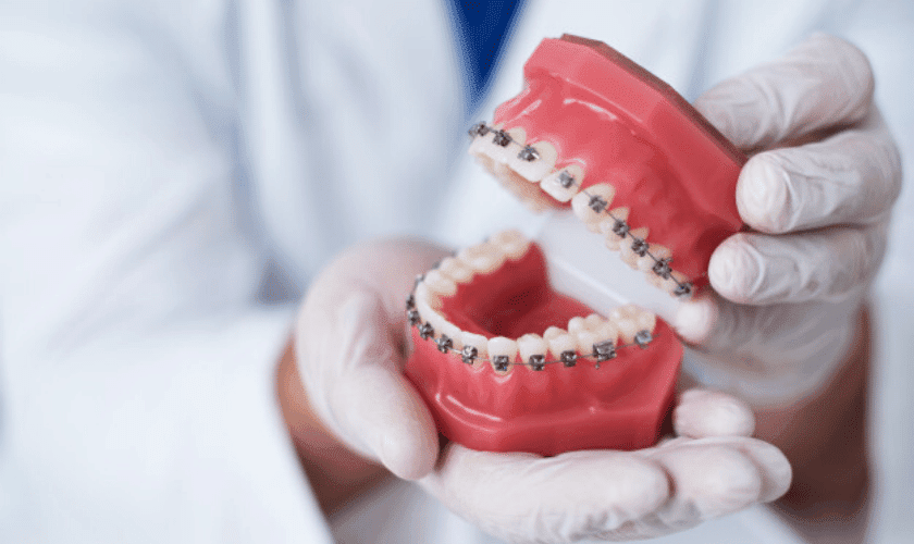 Teeth Alignment cost in India