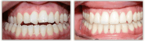 Orthodontic treatment before and after