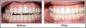 crossbite before and after