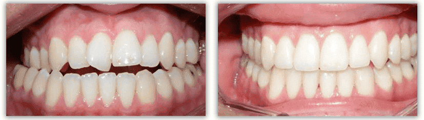 Crossbite before and after treatment
