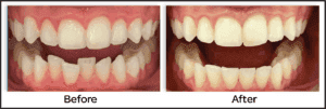 midline before and after