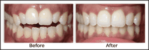 openbite before and after