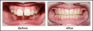 overbite before and after