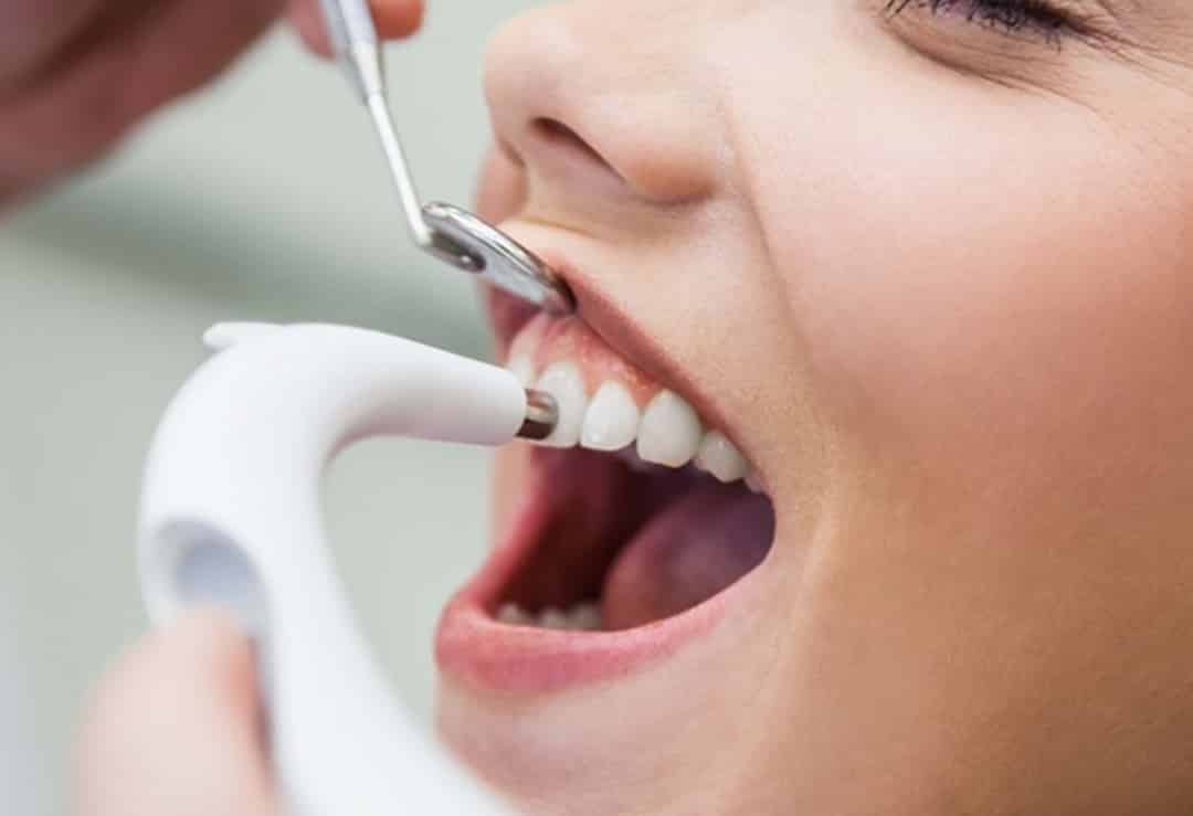 the-benefits-of-dental-polishing-a-comprehensive-guide