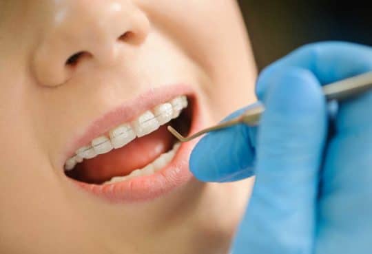 METAL VS CERAMIC ஏது BEST, Cost / Price of Braces in Chennai Madurai  Coimbatore