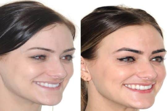 face after braces