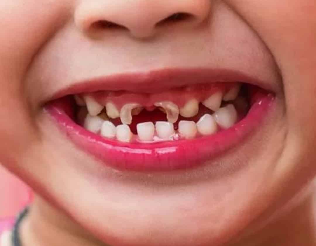 Is it common to have a cavity in kids?