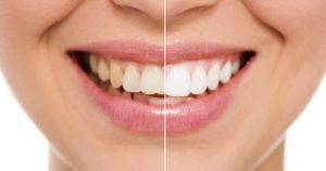 best-dentist-for-teeth-whitening-in-mumbai