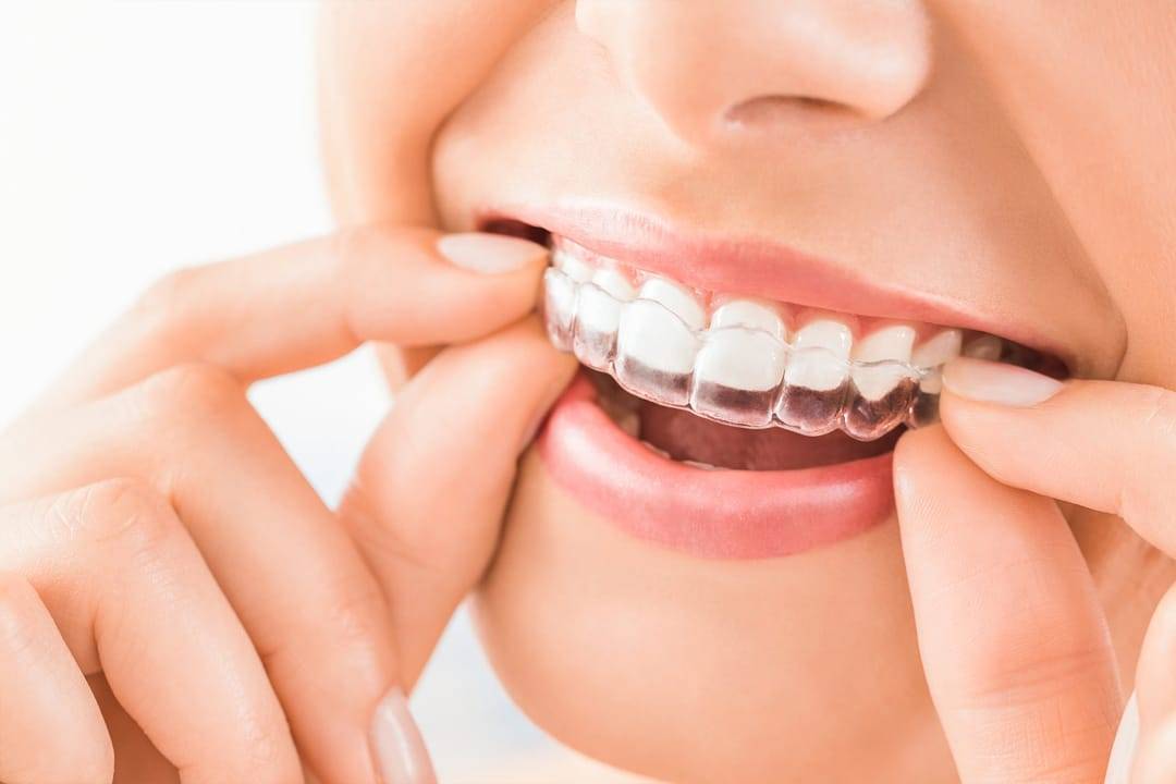 How to Make Clear Braces More PainFree