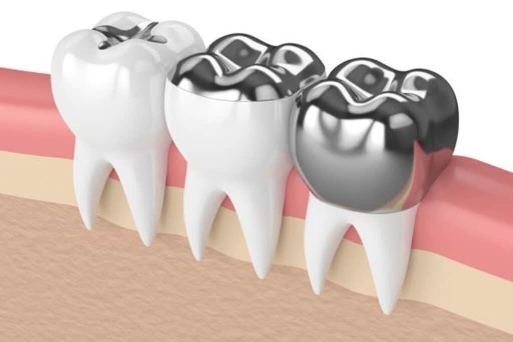 What are the 3 types of Crowns?