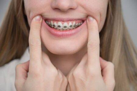 Why Are Metal Braces No More the Right Choice for Teeth Alignment? – Sabka  Dentist – Top Dental Clinic Chain In India