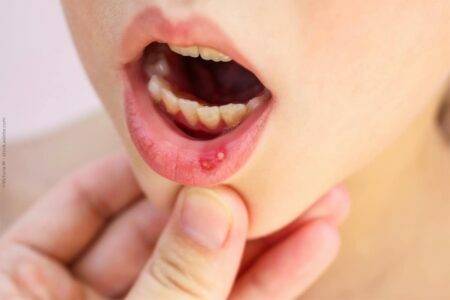 Canker sores