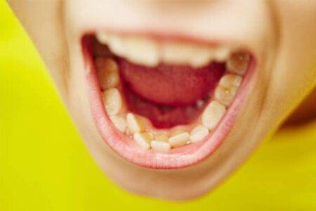 Misaligned teeth
