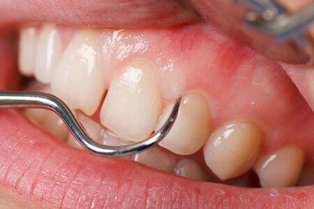 Tooth scaling