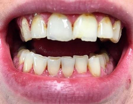 What is tooth enamel erosion