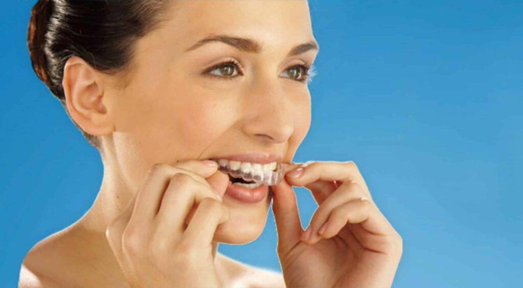 Orthodontic Treatment with Clear Aligners