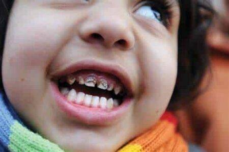 Kids tooth decay