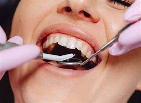 dental scaling