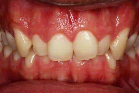 overbite
