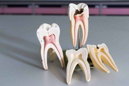root-canal