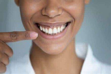 smile makeover