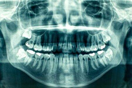 tooth X-rays