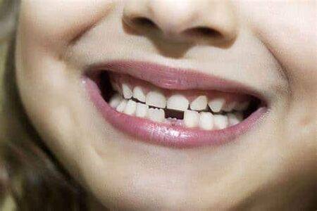 tooth loss