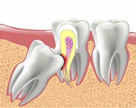 wisdom tooth
