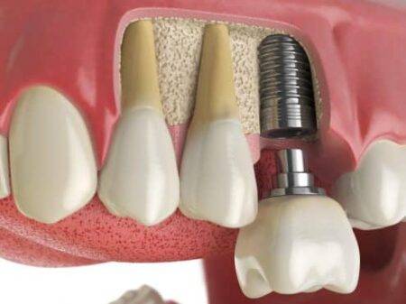 dental impalnts