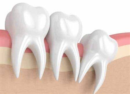 wisdom teeth